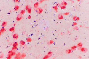 Claiming Compensation for a Delayed Sepsis Diagnosis