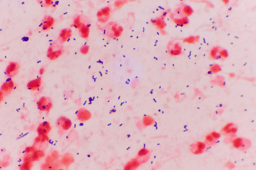 Claiming Compensation for a Delayed Sepsis Diagnosis