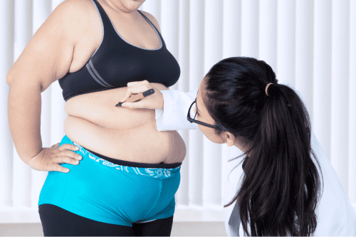 Tummy Tuck Gone Wrong - Claiming Compensation